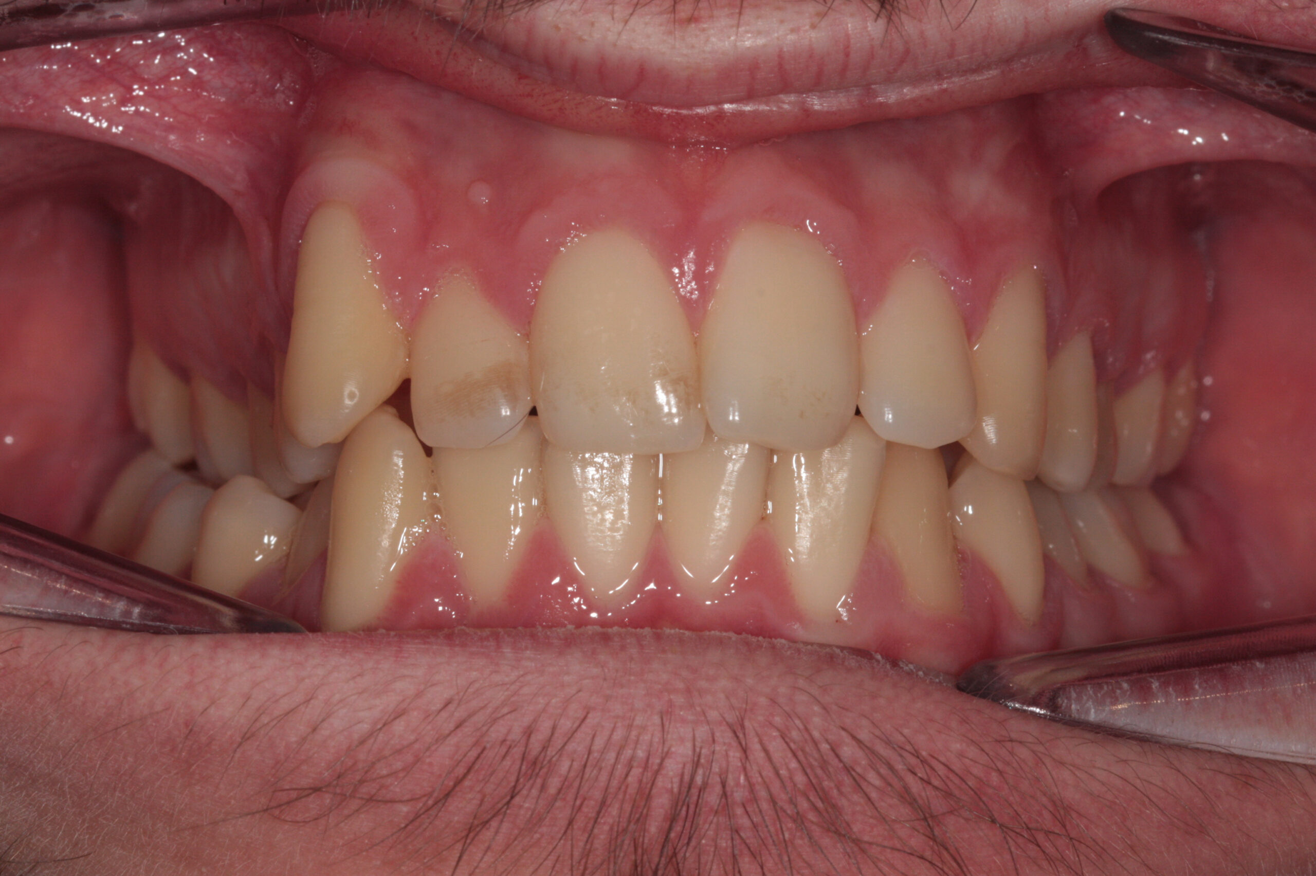 Crowding - aligners before treatment