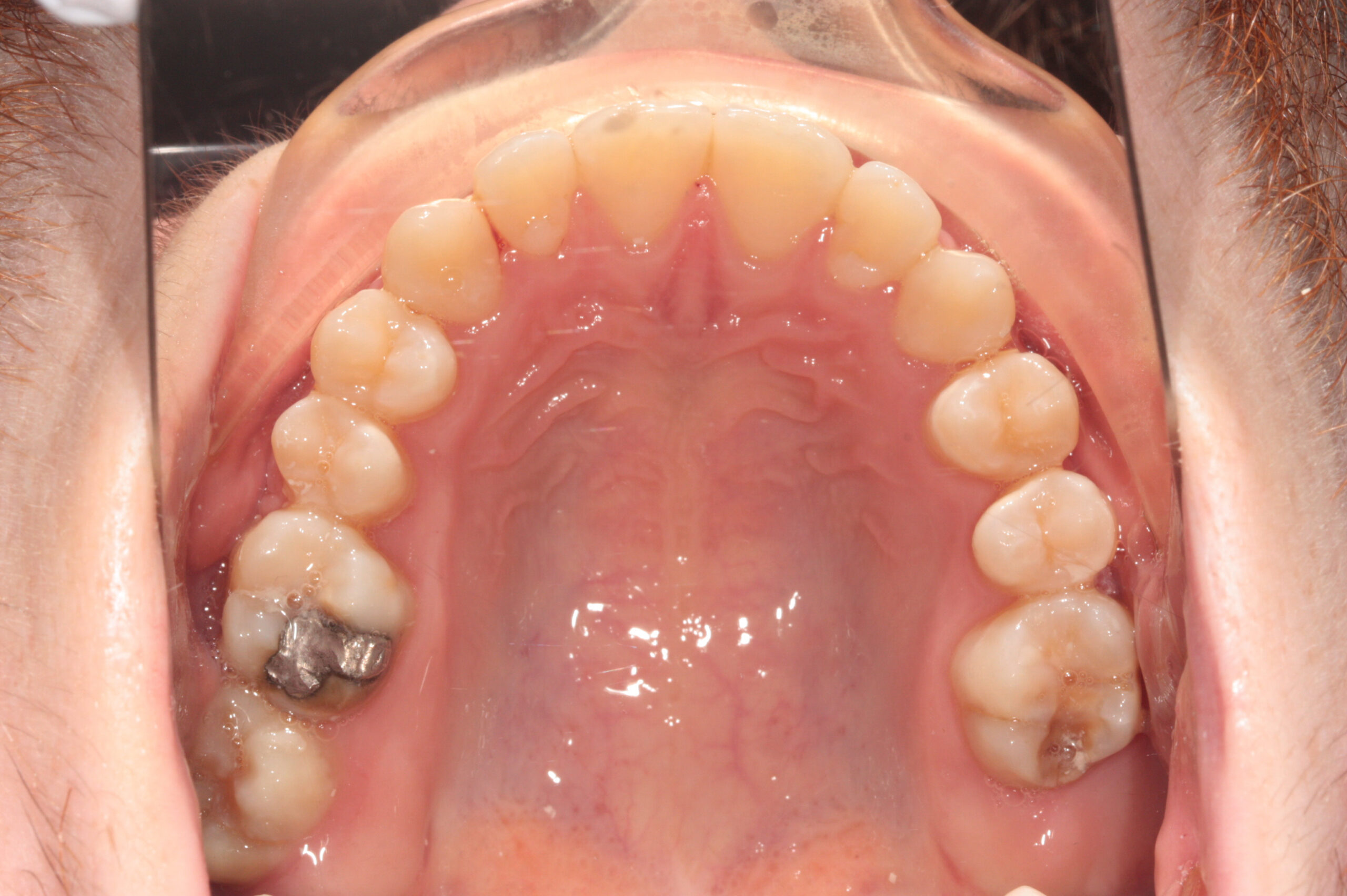 Crowding - fixed braces after treatment