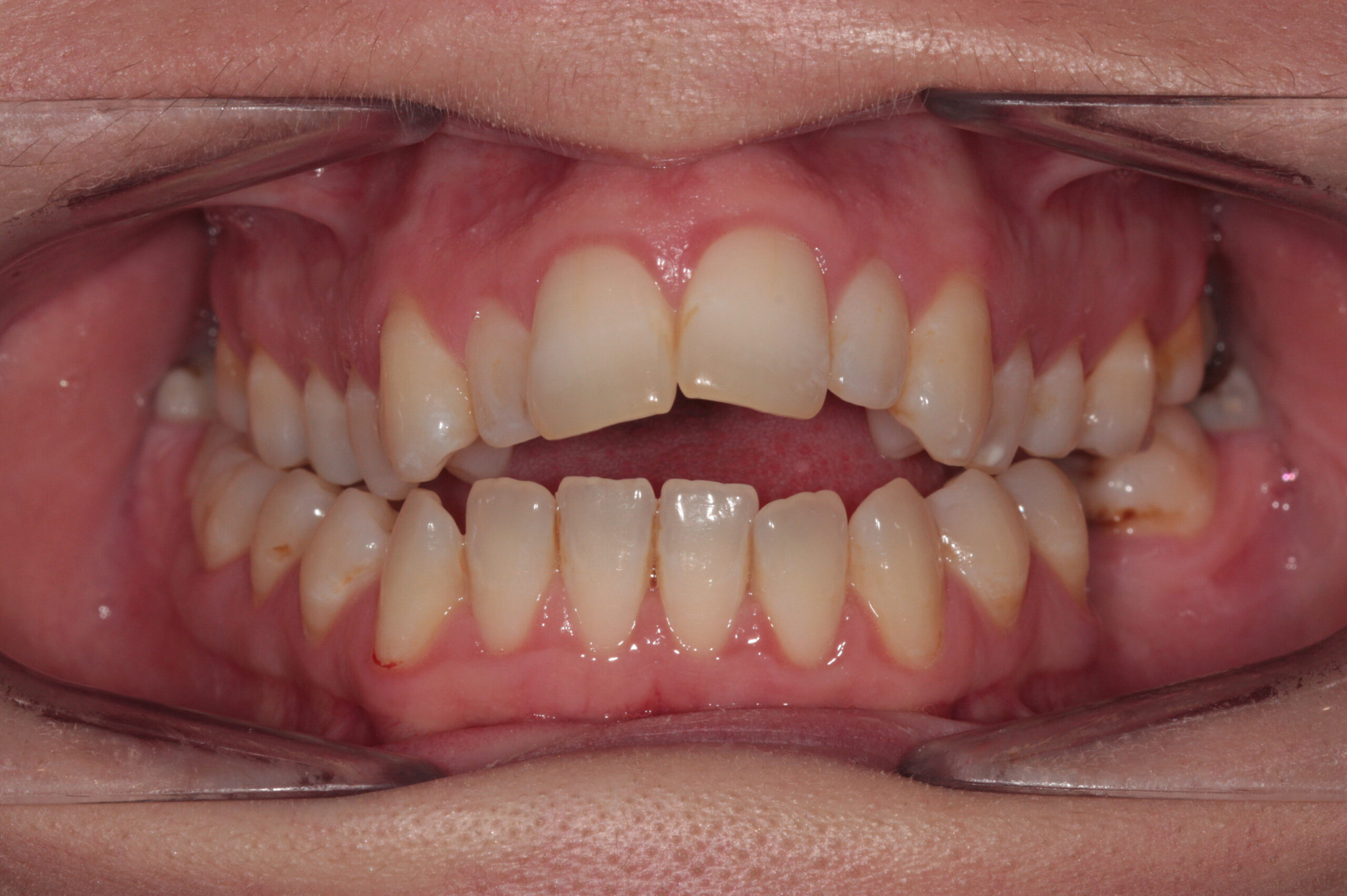 Open bite - fixed clear braces before treatment