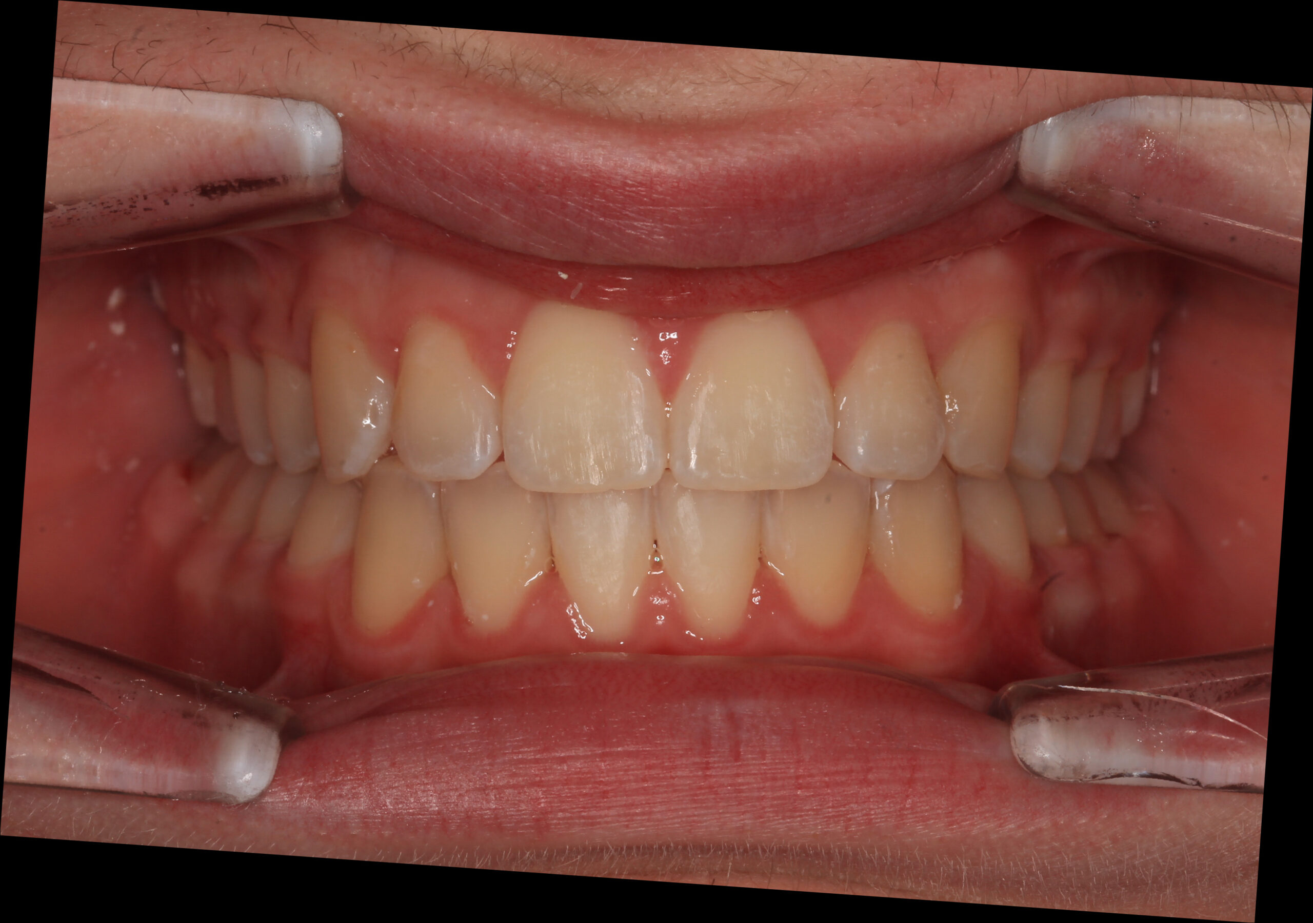 Crowding and asymmetric bite after treatment