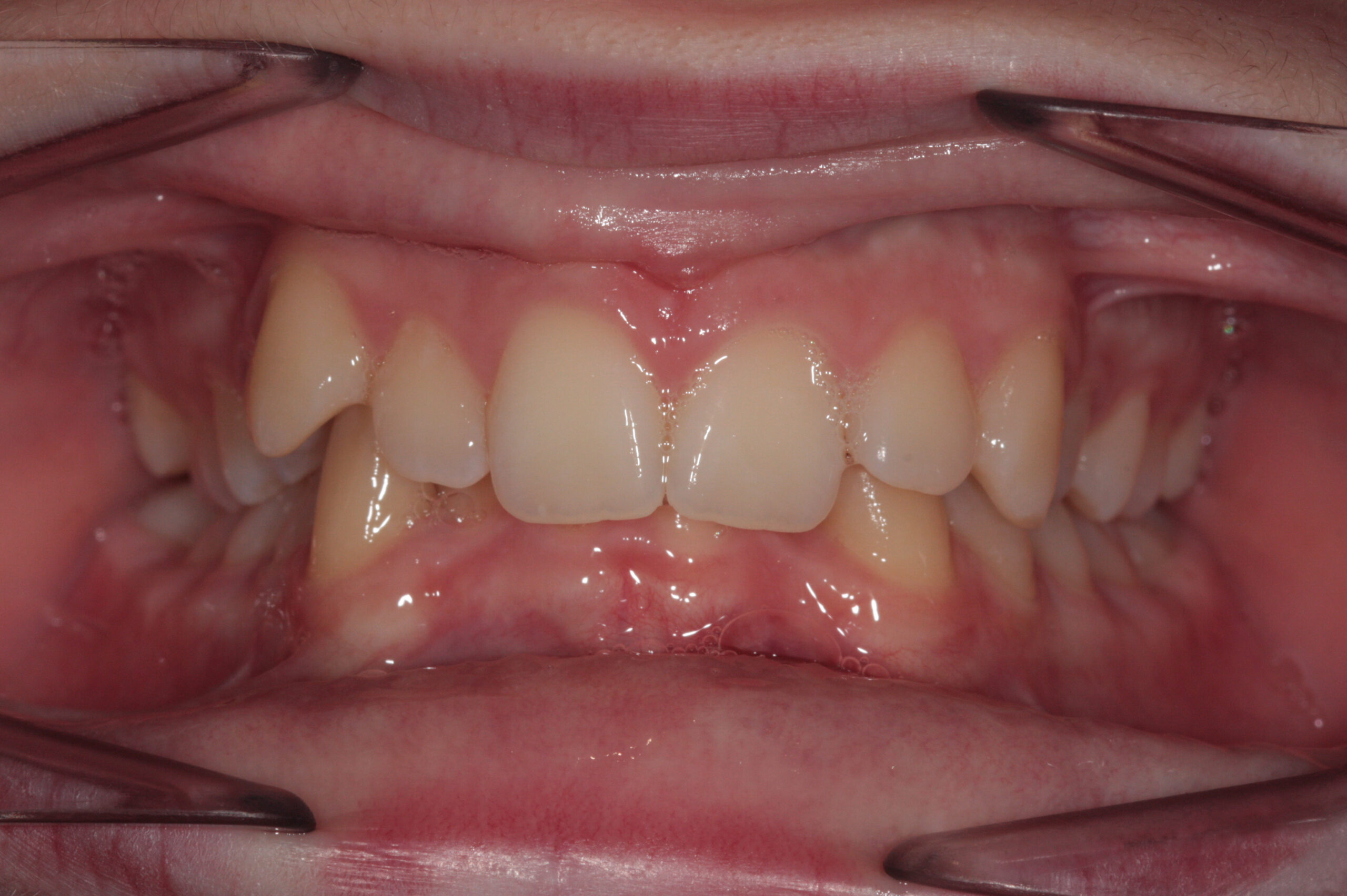 Crowding and asymmetric bite before treatment