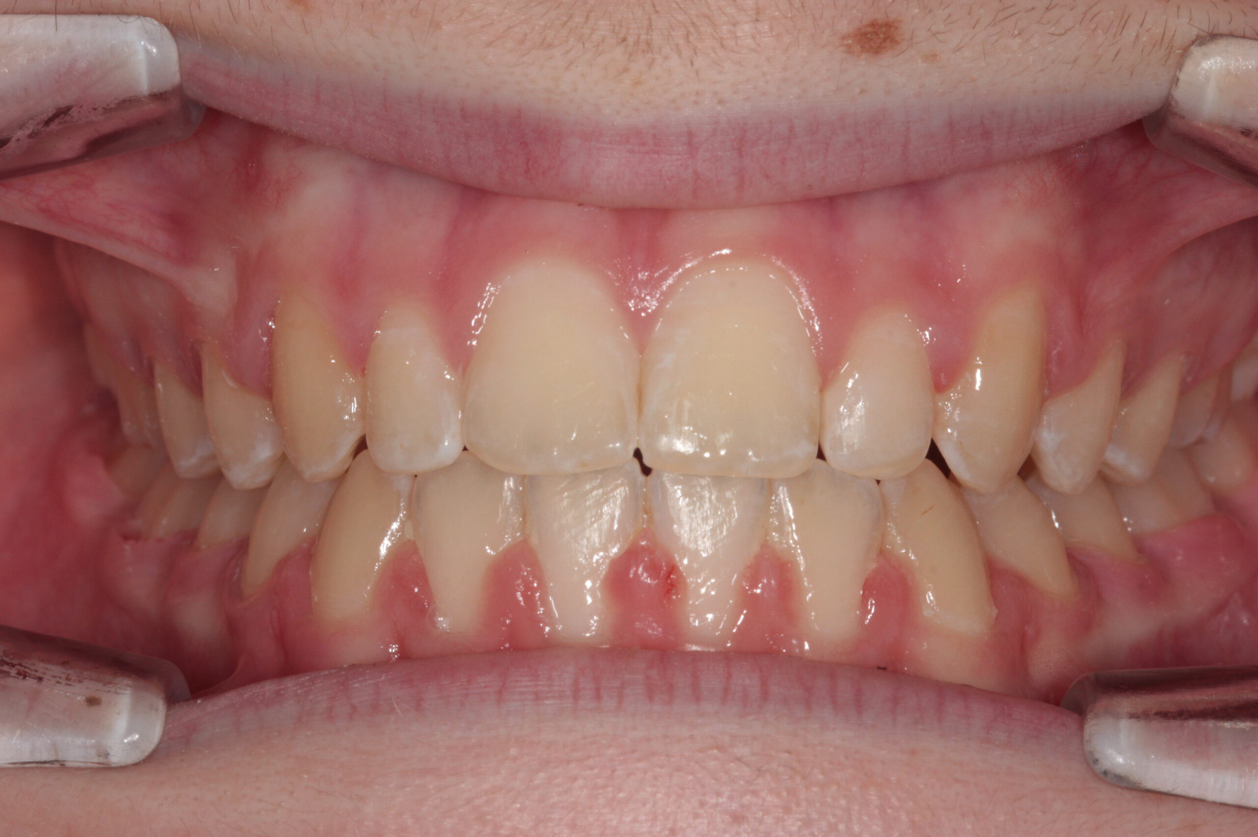 Crossbite - fixed braces after treatment