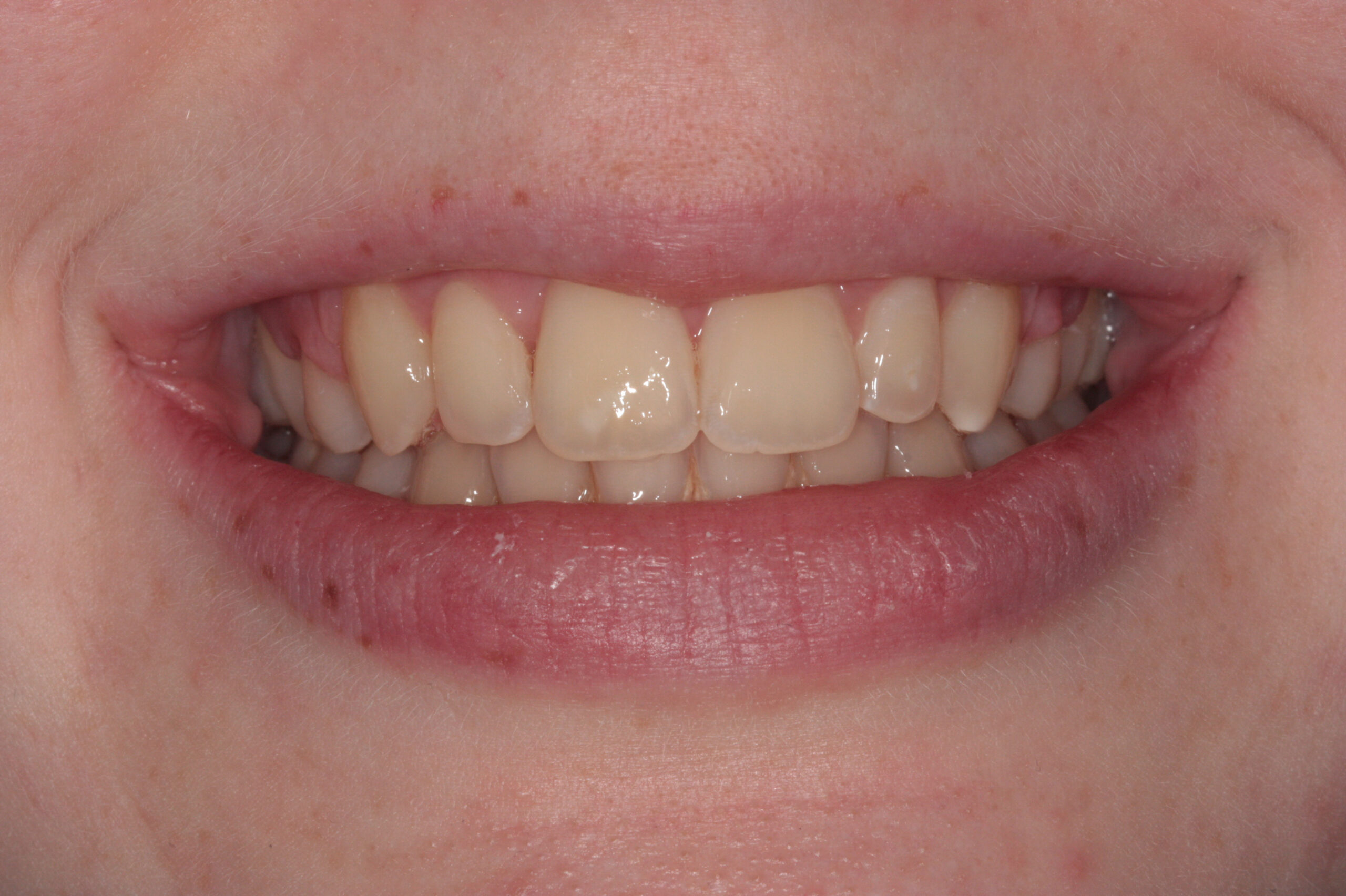 Crowding and extractions after treatment