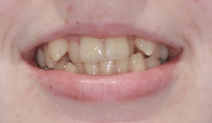 Crowding and extractions before treatment