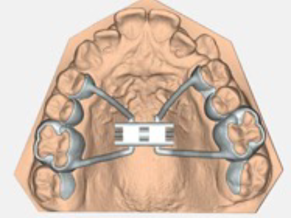 Orthodontic palatal expander