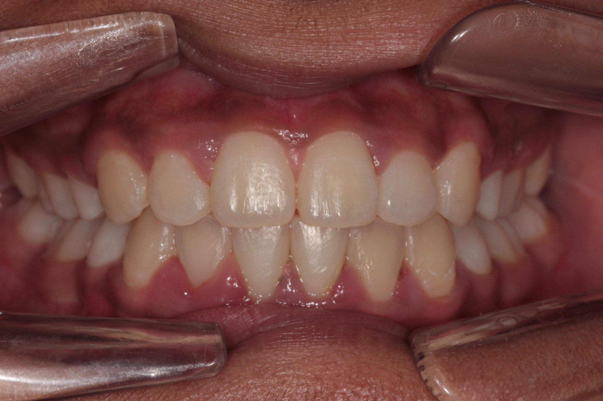 Crowding with extractions after treatment