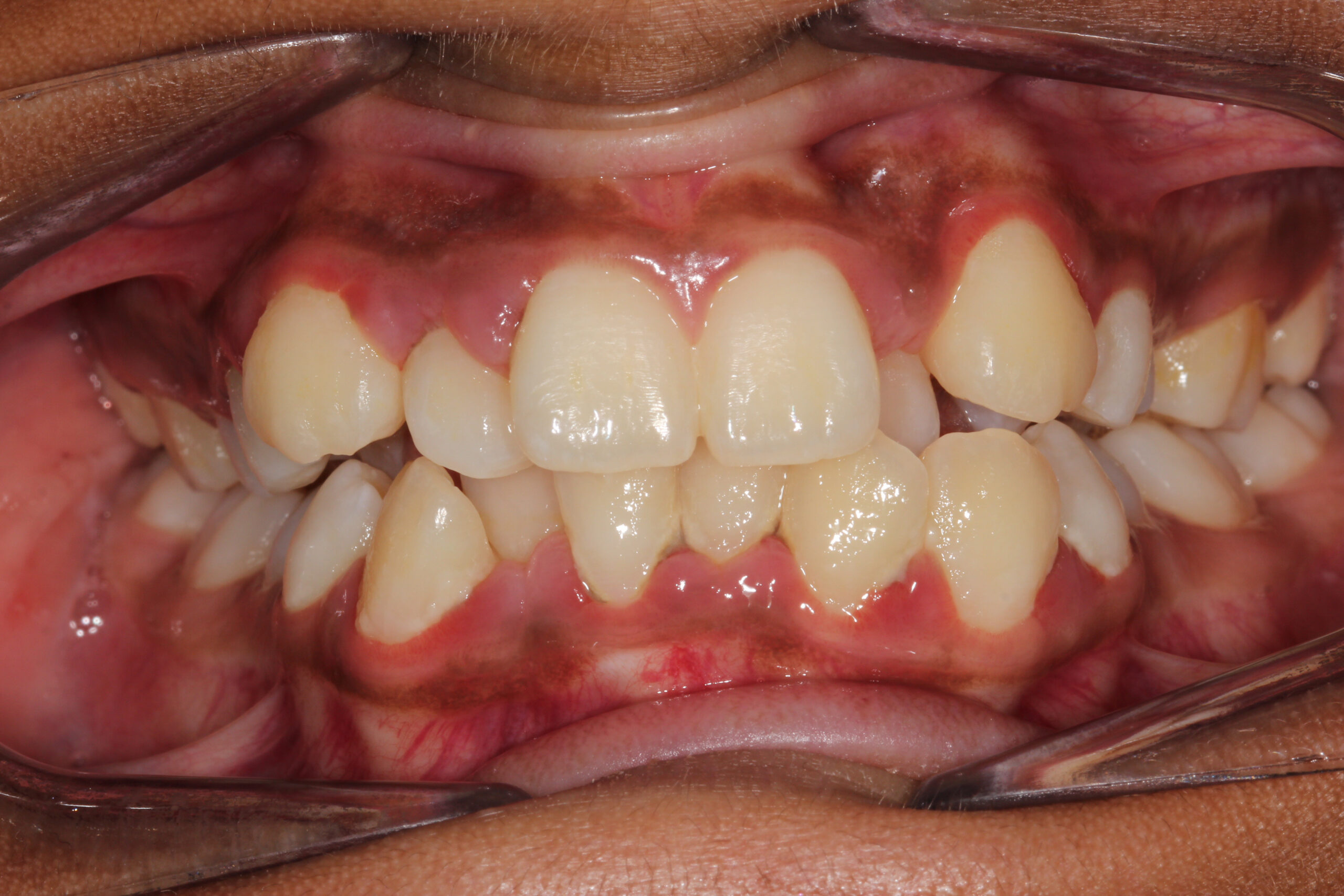 Crowding with extractions before treatment