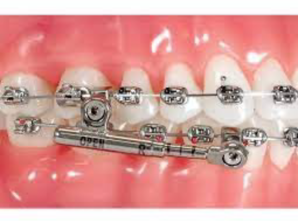 Functional orthodontic appliance