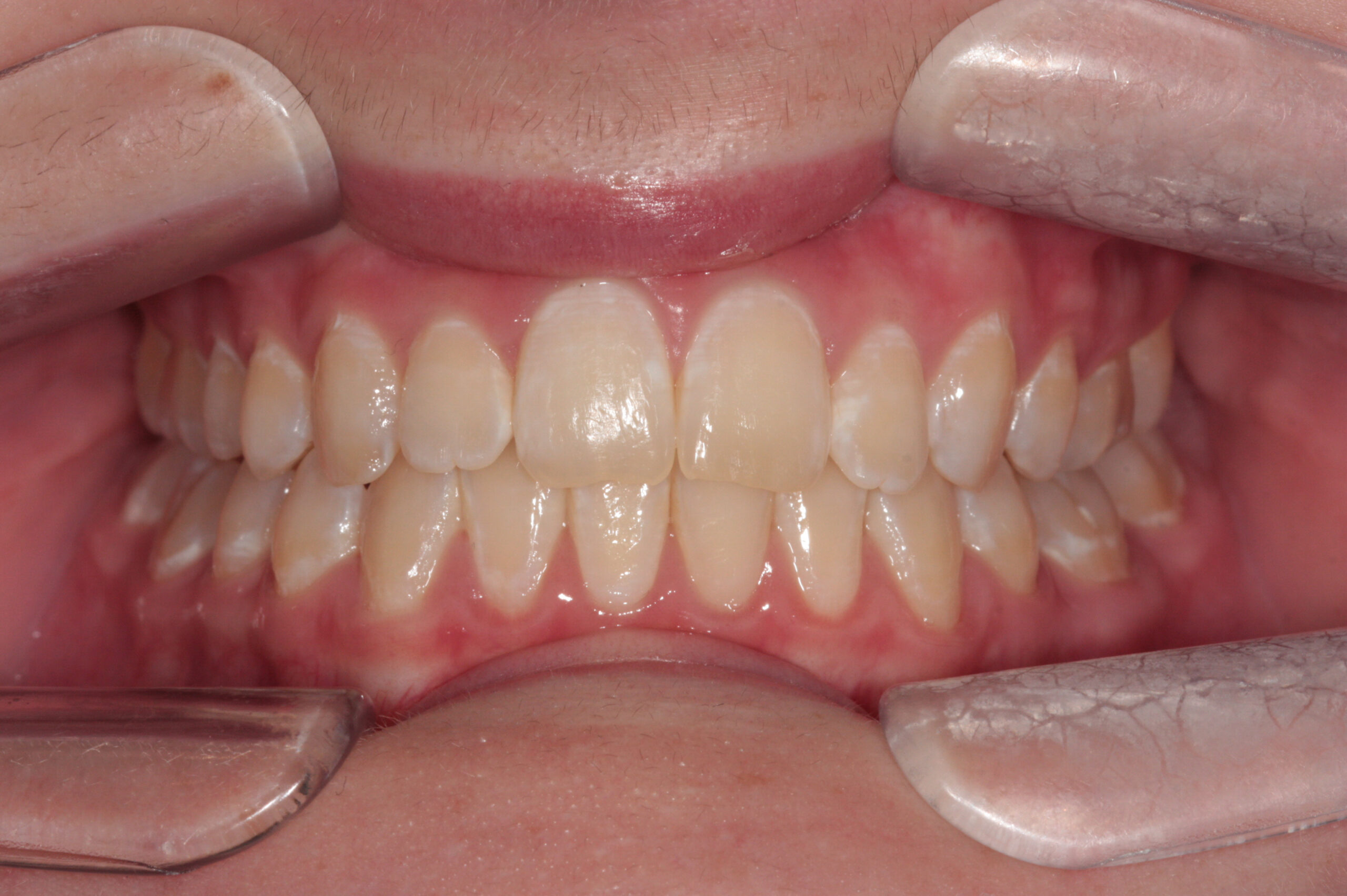Functional and fixed braces after treatment