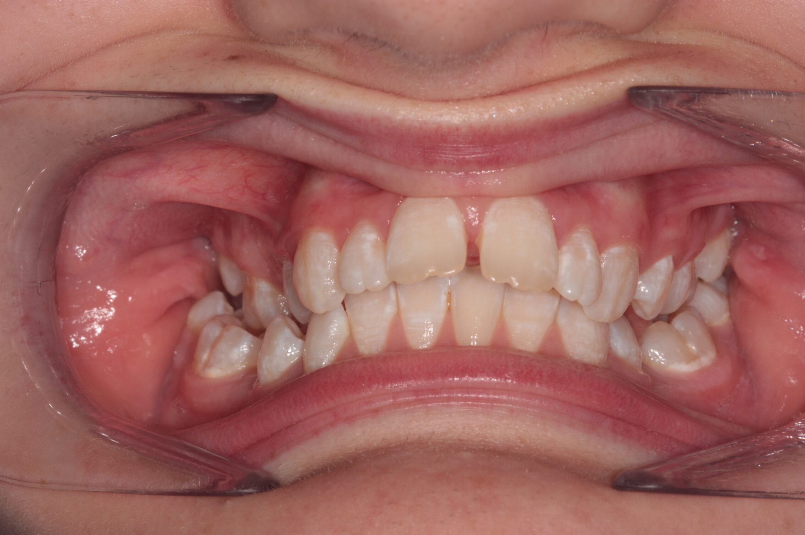 Functional and fixed braces before treatment