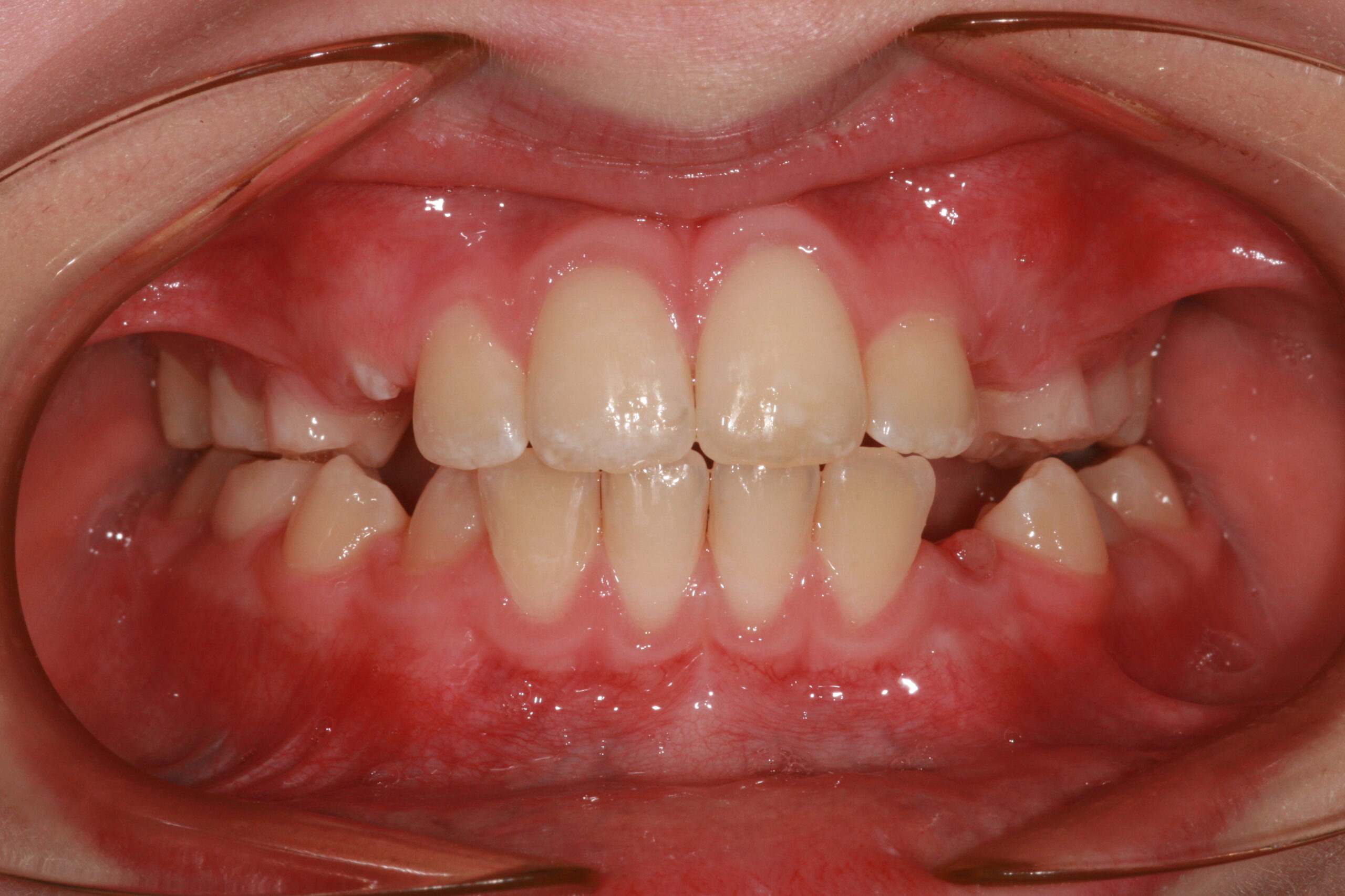 Open bite - interceptive aligners after treatment
