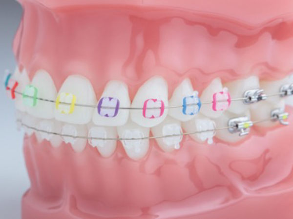 Phase 1 braces