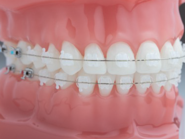 Clear aligners for teenagers